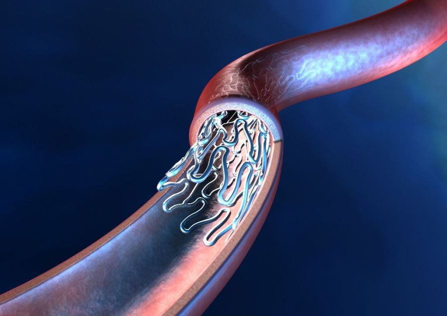 Health Management and Leadership Portal Coronary stent / metal / bare