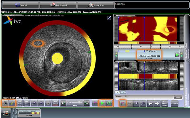 Intravascular imaging system TVC Composite™ Image Infraredx Intravascular imaging system TVC Composite™ Image Infraredx