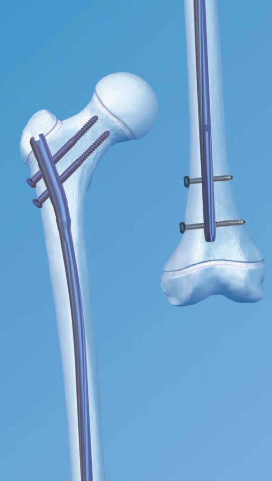 Health Management and Leadership Portal | Human intramedullary nail