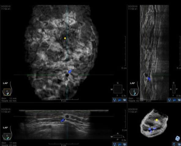 Ultrasound system / on platform / for breast ultrasound imaging somo?v ABUS INSIGHT U-Systems Ultrasound system / on platform / for breast ultrasound imaging somo?v ABUS INSIGHT U-Systems