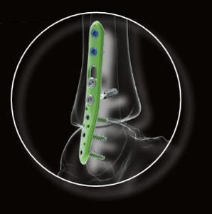 Health Management and Leadership Portal | Tibia osteotomy plate ...