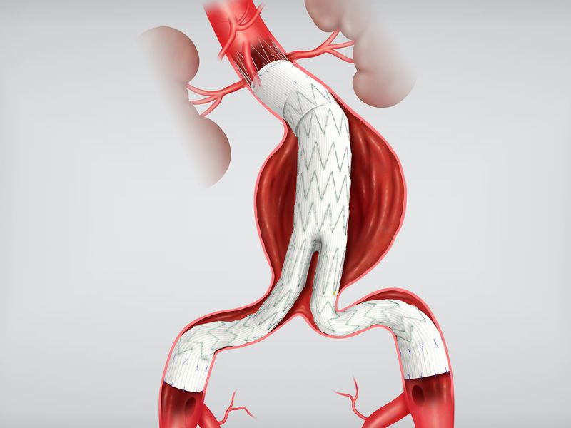 Health Management And Leadership Portal Endovascular Stent Graft