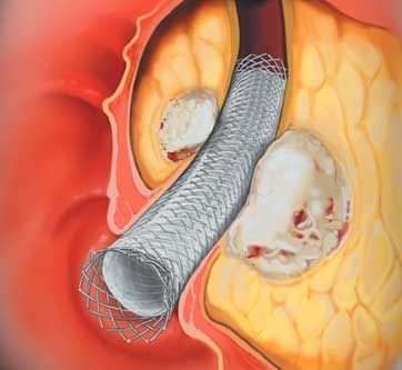 stent biliary polymer healthmanagement