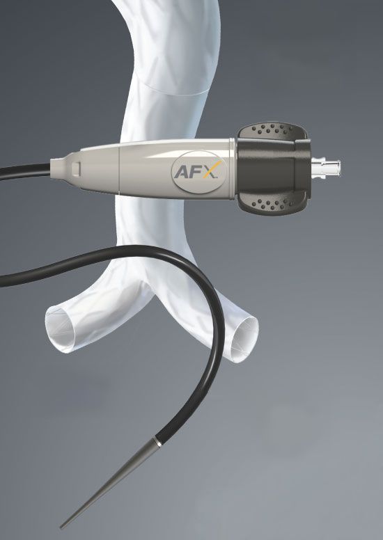 Abdominal stent graft AFX Endologix Abdominal stent graft AFX Endologix