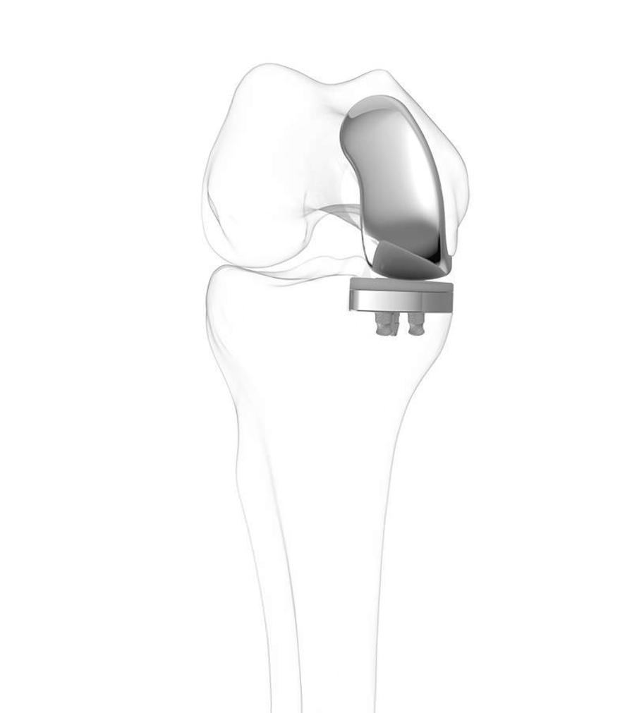 Health Management And Leadership Portal Three Compartment Knee