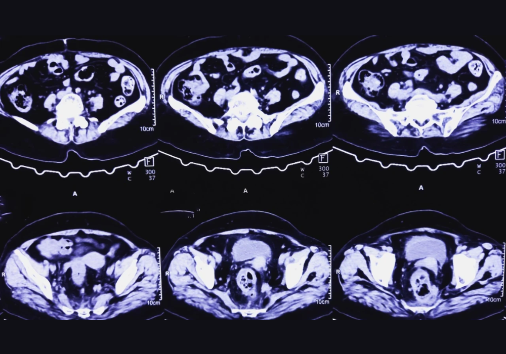 Pelvic MRI scan, supporting gynaecological imaging, pelvic anatomy assessment and diagnostic care planning.