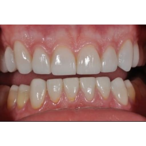 After photo of Case ID: 0831 - Full Mouth Reconstruction 