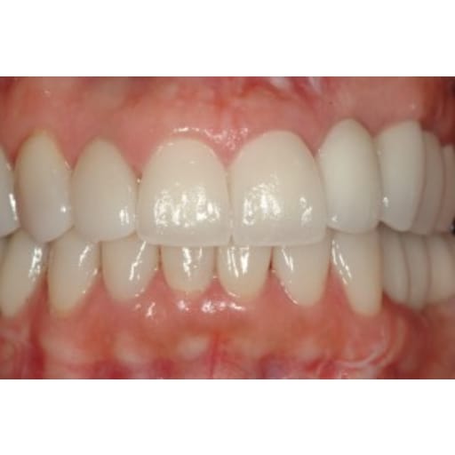 After photo of Case ID: 0365 - Full Mouth Reconstruction 