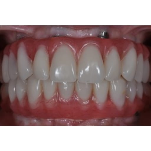 After photo of Case ID: 0321 - One Day Dentistry 