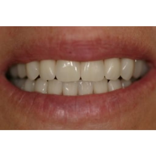 After photo of Case ID: 0318 - One Day Dentistry 