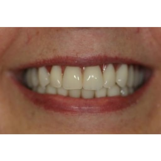 After photo of Case ID: 0315 - One Day Dentistry 