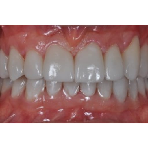 After photo of Case ID: 0337 - Porcelain Veneers