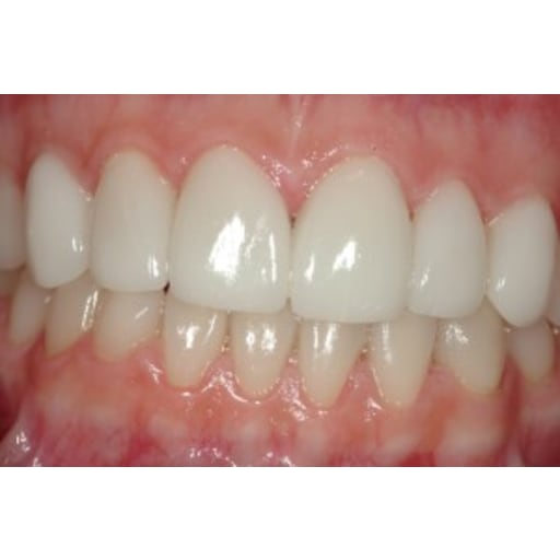 After photo of Case ID: 0330 - Porcelain Veneers