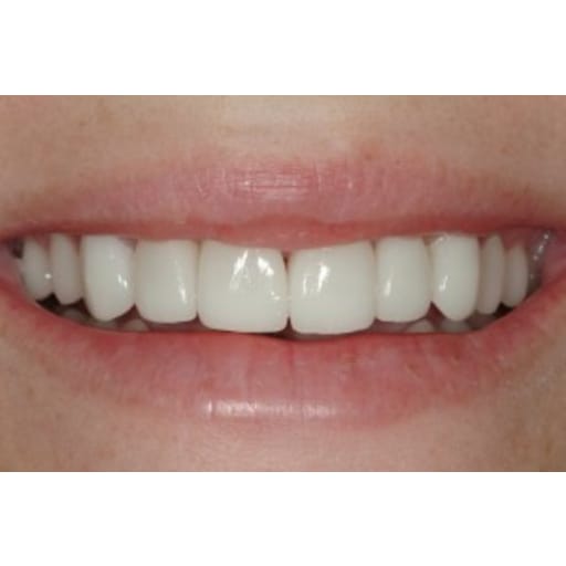 After photo of Case ID: 0327 - Porcelain Veneers