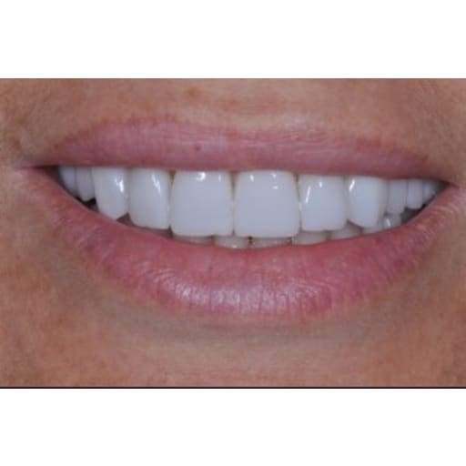 After photo of Case ID: 0613 - Smile Makeover