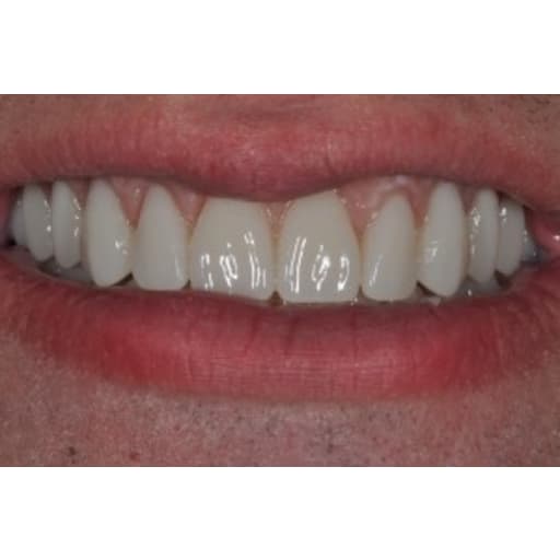 After photo of Case ID: 0524 - Smile Makeover