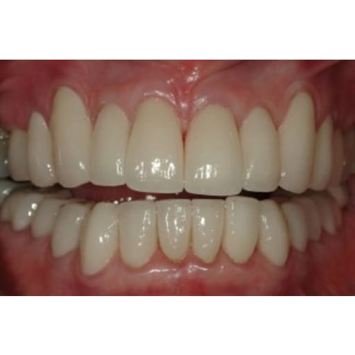 After photo of Case ID: 0362 - Smile Makeover