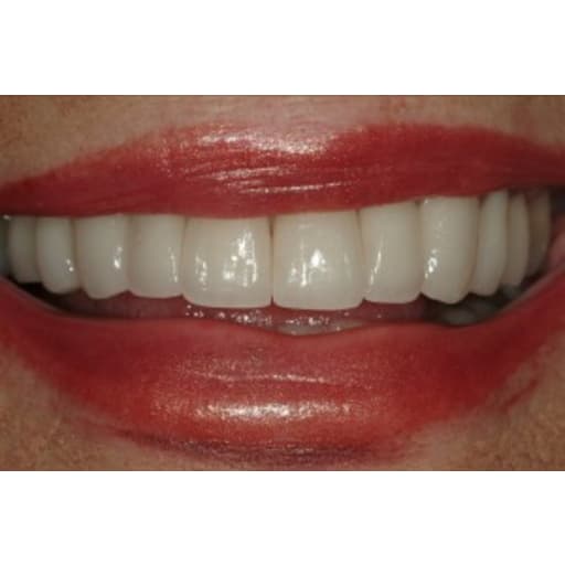 After photo of Case ID: 0358 - Smile Makeover