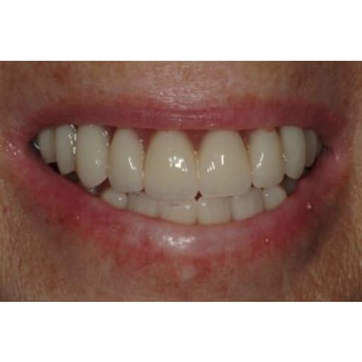 After photo of Case ID: 0520 - Smile Makeover