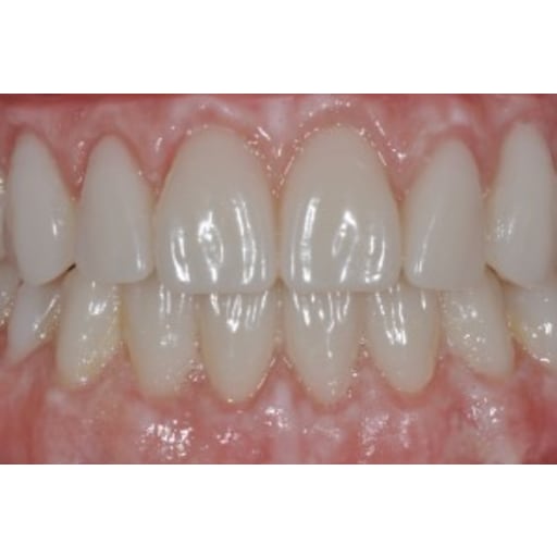 After photo of Case ID: 0524 - Smile Makeover