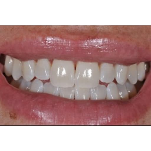 After photo of Case ID: 0739 - Zoom Whitening 