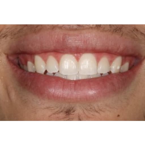 After photo of Case ID: 0846 - Zoom Whitening 