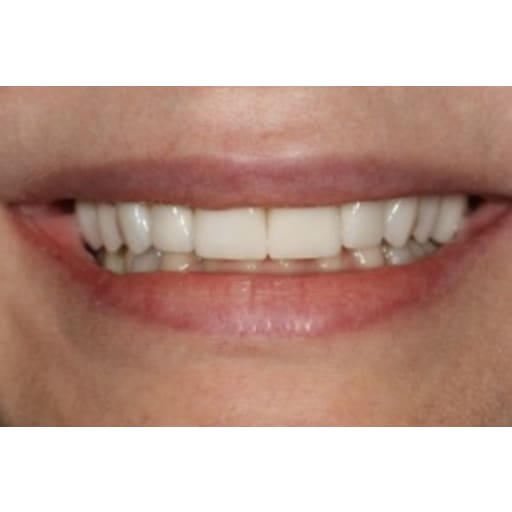 After photo of Case ID: 0864 - Porcelain Veneers