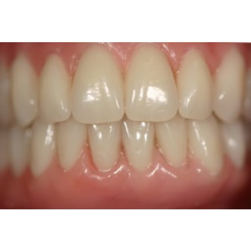 After photo of Case ID: 0324 - One Day Dentistry 