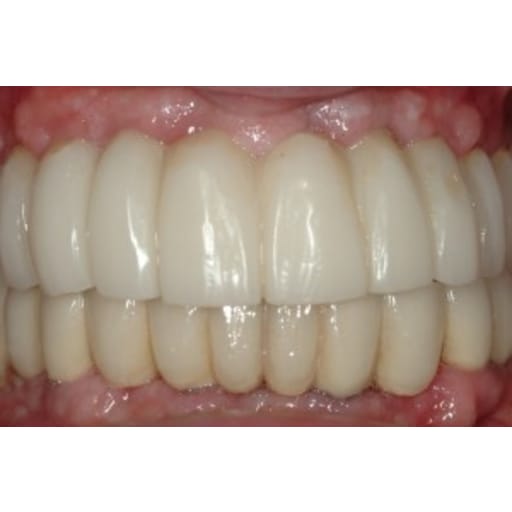 After photo of Case ID: 0374 - Full Mouth Reconstruction 