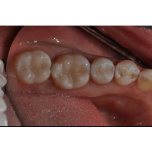 After photo of Case ID: 0751 - Posterior Composites