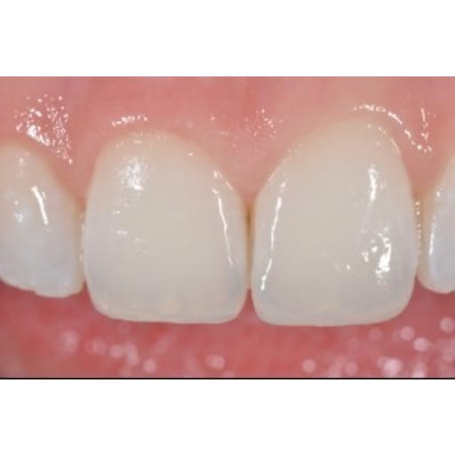 After photo of Case ID: 0754 - Anterior Composites