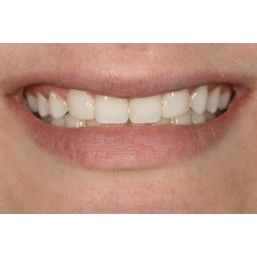 After photo of Case ID: 0852 - Composite Restorations