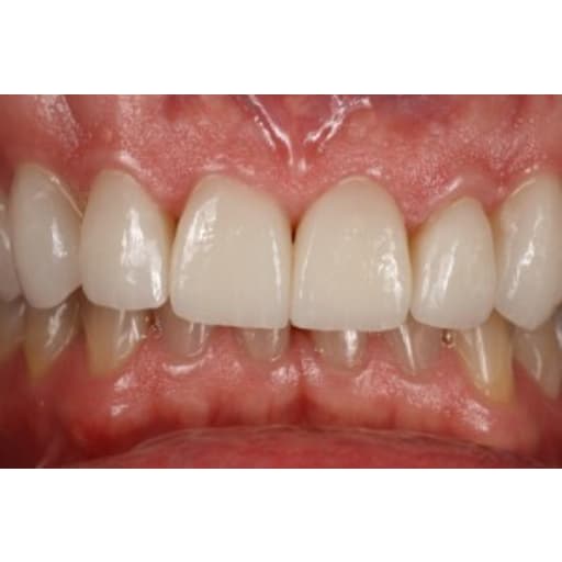 After photo of Case ID: 0512 - All Porcelain Crowns 