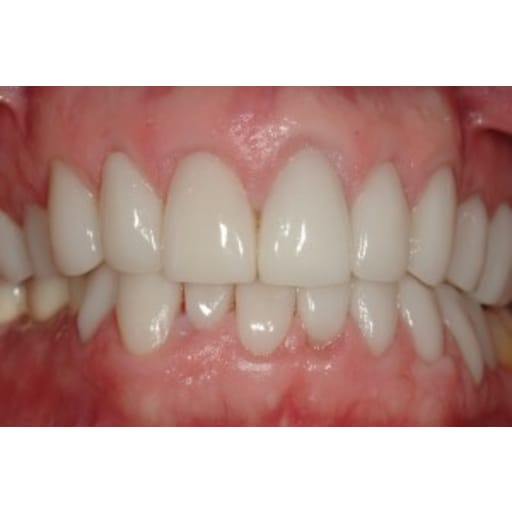 After photo of Case ID: 0349 - All Porcelain Crowns 