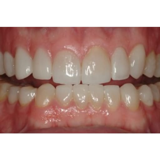 After photo of Case ID: 0343 - All Porcelain Crowns 