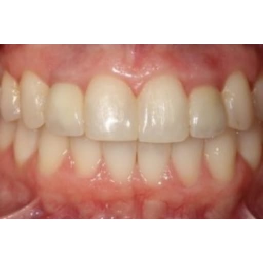 After photo of Case ID: 0858 - Anterior Dental Implants