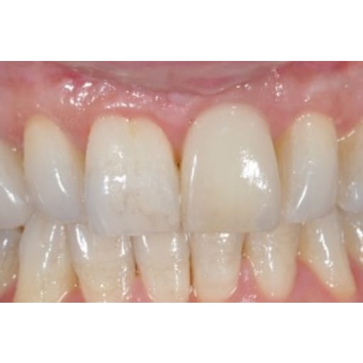 After photo of Case ID: 0449 - Dental Implants 