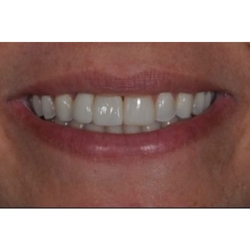 After photo of Case ID: 0843 - Anterior Dental Implants 