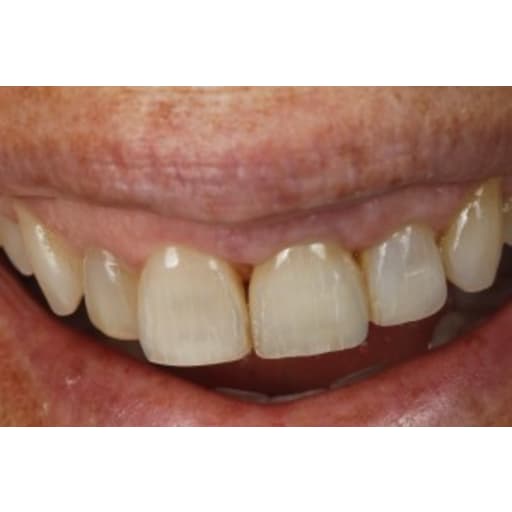 After photo of Case ID: 0604 - Dental Implant 