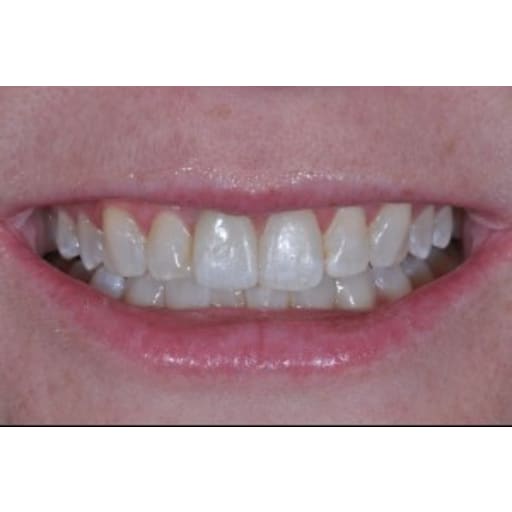 After photo of Case ID: 0590 - Dental Implant 