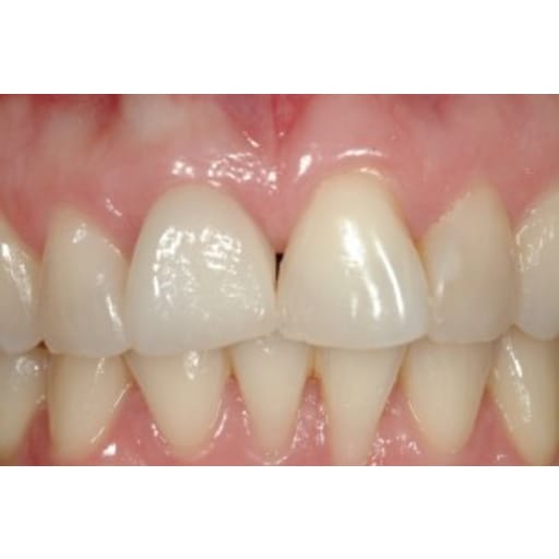 After photo of Case ID: 0380 - Dental Implant 