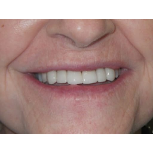 After photo of Porcelain Veneers - Porcelain Veneers