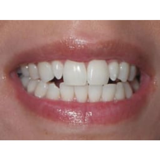 After photo of Zoom Whitening - 