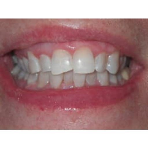 After photo of Zoom Whitening - 