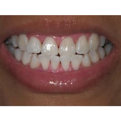 After photo of Zoom Whitening - 