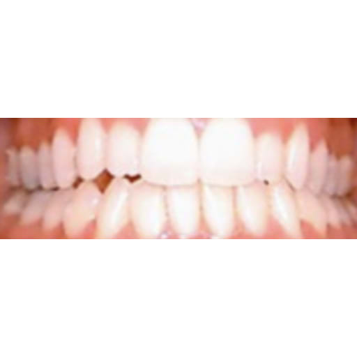 After photo of Invisalign – Overly Crowded - 