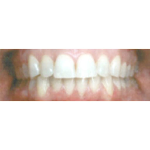 After photo of Invisalign – Overbite - 