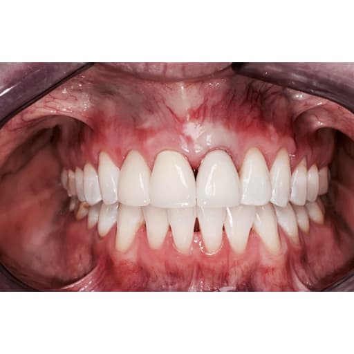 After photo of Implants + Teeth Whitening  - 