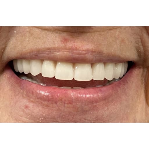 After photo of Dentures - 