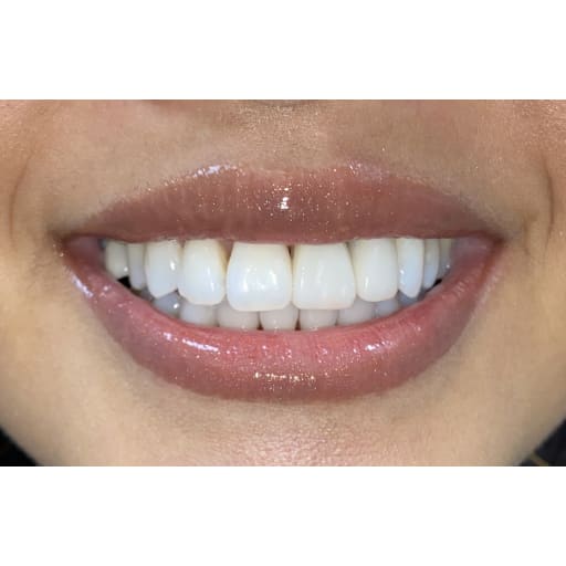 After photo of Implants + Ortho + Teeth Whitening  - 